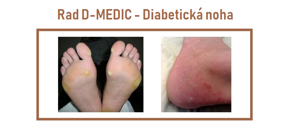 diabeticka noha sk